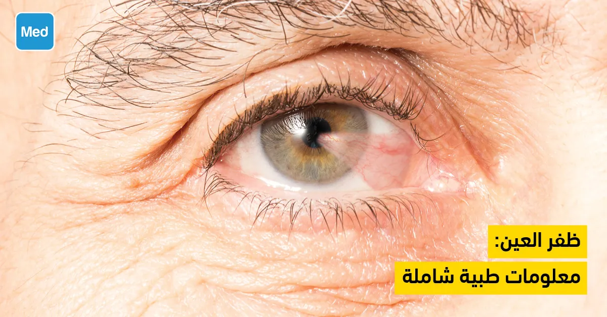 ظفر العين: معلومات طبية شاملة